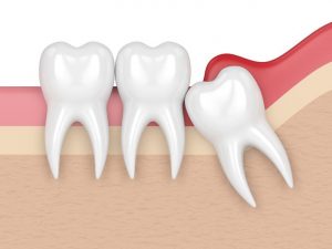 wisdom tooth extraction removal services
