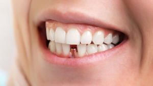 Dentist tools ready for implants
