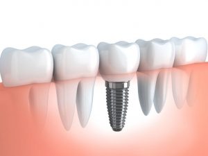 dental implants bone grafting