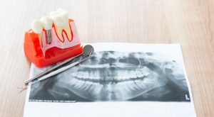 oral surgery dental implant bone distraction