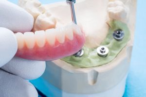 dental implants surgery dentists