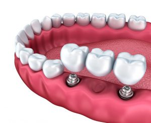 dental implants types of questions
