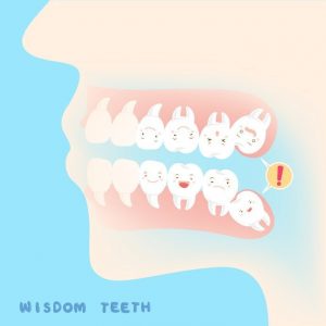 recommended wisdom tooth extraction impacted